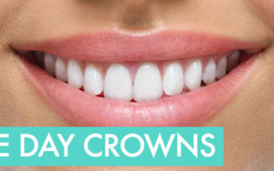 Same Day Crowns at Matonti Dental